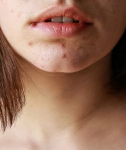 Acne Scar Treatment Surrey
