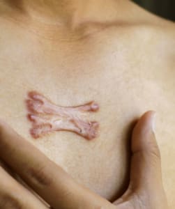 Keloid Scar Treatment Marylebone