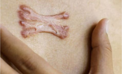 What are Keloid Scars: Understanding the Causes and Treatment Options