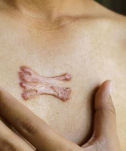 Keloid Scar Removal Surrey