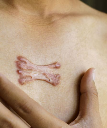 What are Keloid Scars: Understanding the Causes and Treatment Options